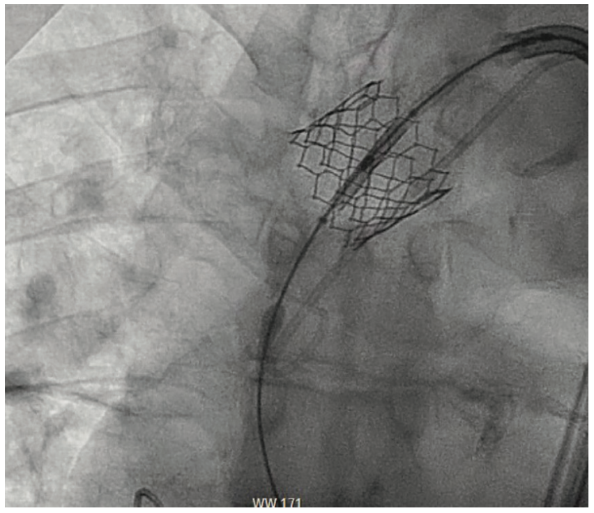 Embolization of Prosthetic Valve Into the Ascending Aorta During